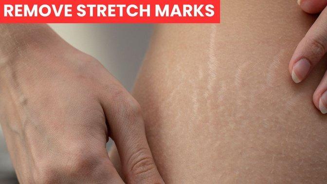 How to Remove Stretch Marks Fast: A Simple and Effective Home Remedy!