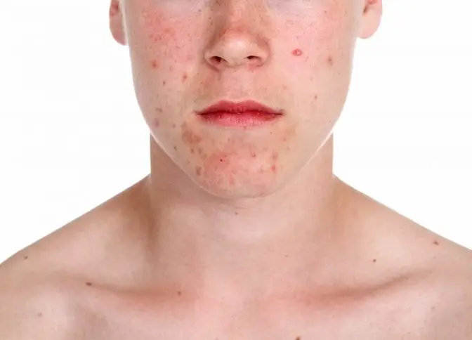 Огромная польза бобов мунг для здоровья